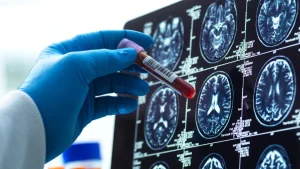 Alzheimer: un nuevo análisis de sangre permitiría detectar la enfermedad años antes