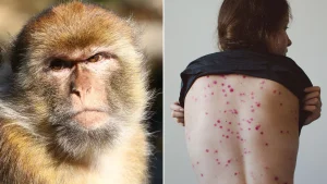 Detectaron un caso importado de Mpox en San Juan y descartaron contagios locales